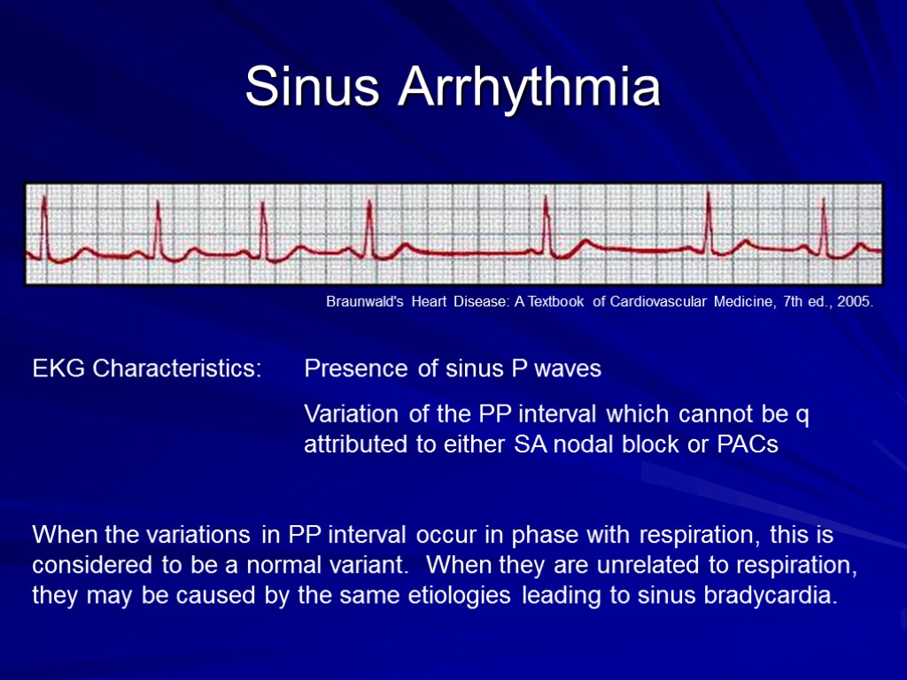 Sinus Arrhythmia EKG Characteristics: Presence of sinus P waves Variation of the PP interval